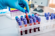 Những người nhóm máu A có nguy cơ nhiễm virus Vũ Hán cao hơn?